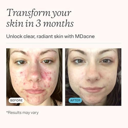 MDacne Acne Treatment - Benzoyl Peroxide Cream 5% for Sensitive Skin | Unclogs Pores & Reduces Blemishes Avelisse