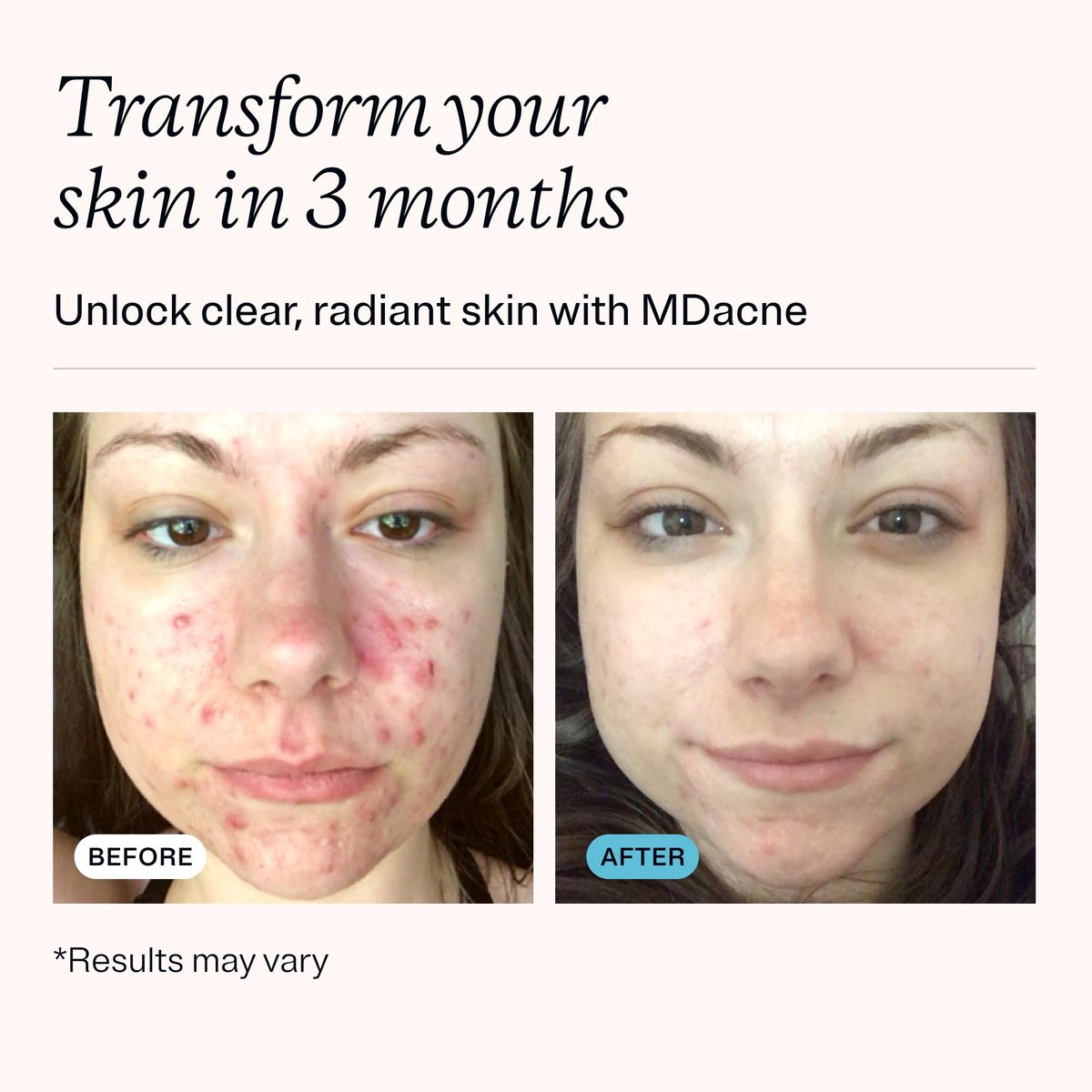 MDacne Acne Treatment - Benzoyl Peroxide Cream 5% for Sensitive Skin | Unclogs Pores & Reduces Blemishes Avelisse