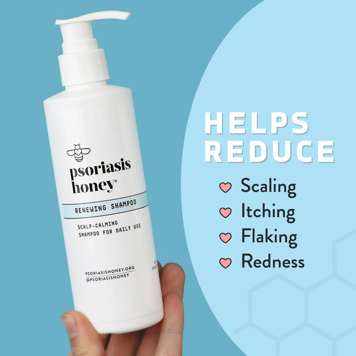 PSORIASIS HONEY Renewing Shampoo – Itchy & Dry Scalp Treatment with Argan Oil for Women, Men & Kids (8 oz) Avelisse
