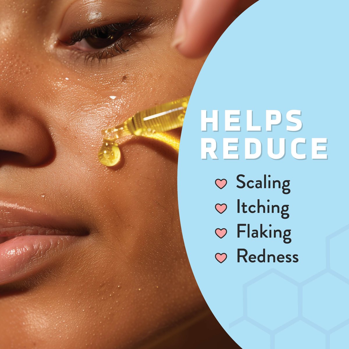 Psoriasis Honey Nourishing Scalp & Skin Serum - Dry Oil for Skin - Full Body Non Comedogenic Moisturizer Daily Dry Scalp Oil - Helps Psoriasis, Eczema, & More (1 Oz) Avelisse