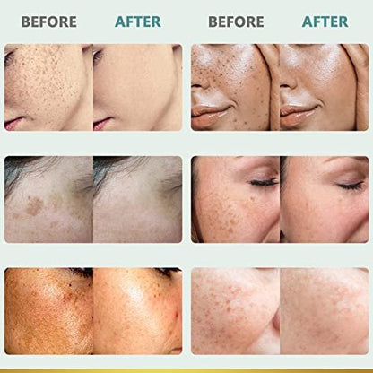 CITYGOO Dark Spot Remover for Face - Dark Spot Corrector Cream for Melasma, Freckles, Sun Spots & Blemishes - Enriching Skincare for All Skin Tones - 1.7 FL OZ Avelisse