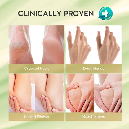 Vebuni Urea Cream 42% + Salicylic Acid - Intensive Callus Remover for Feet, Knees & Elbows, 4 oz - Moisturizes & Softens Dry, Rough Skin