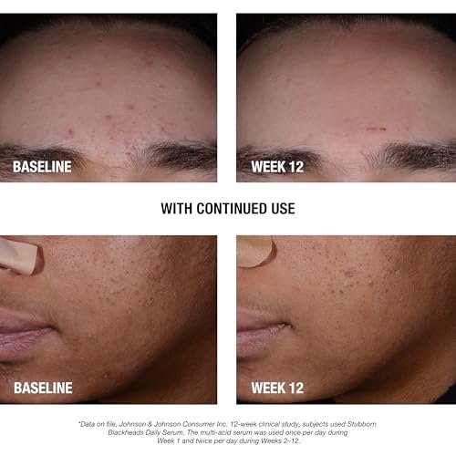 Neutrogena Stubborn Blackheads Daily Acne Facial Serum – Salicylic Acid, Glycolic Acid, Polyhydroxy & Mandelic Acids, Oil-Free, 1 fl. oz Avelisse