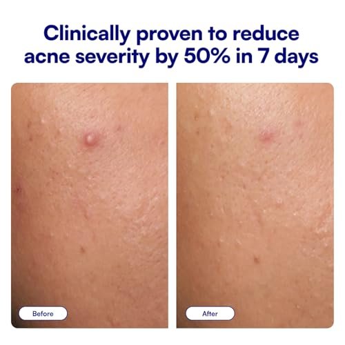 Bliss Clear Genius Acne Spot Treatment – Maximum Strength 2% Salicylic Acid, Shrinks Blemishes, Clean & Vegan, 0.5 Fl Oz Avelisse