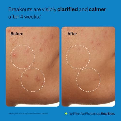 Peach Slices Acne Clarifying Cleanser - 2% Salicylic Acid Acne Treatment with Cucumber & Cica - Vegan, Cruelty-Free Korean Skincare (4.05 oz) - görsel 13