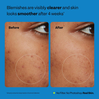 Peach Slices Oil-Free Moisturizer with 2% Salicylic Acid & Hyaluronic Acid - Acne-Prone Skin, Vegan & Cruelty Free, 2.82 oz