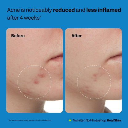 Peach Slices Acne Exfoliating Toner - 2% Salicylic Acid with Lactic & Glycolic Acid, Cucumber - Vegan & Cruelty-Free Korean Skincare (4.05 oz)