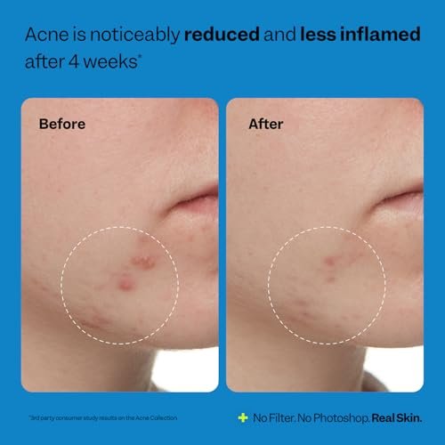 Peach Slices Acne Exfoliating Toner - 2% Salicylic Acid with Lactic & Glycolic Acid, Cucumber - Vegan & Cruelty-Free Korean Skincare (4.05 oz) - görsel 12