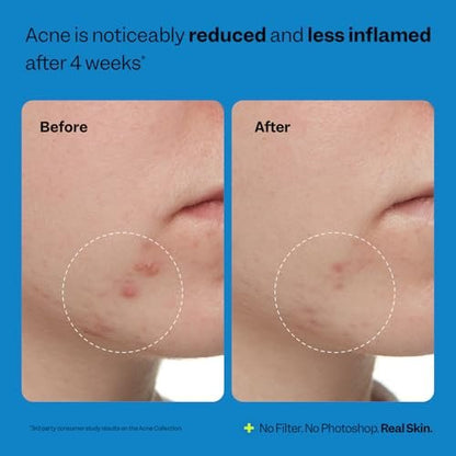 Peach Slices Acne Exfoliating Toner - 2% Salicylic Acid with Lactic & Glycolic Acid, Cucumber - Vegan & Cruelty-Free Korean Skincare (4.05 oz)