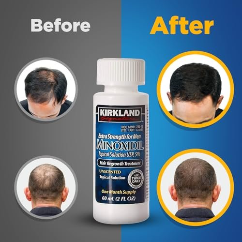 Kirkland Signature 5% Minoxidil Hair Regrowth for Men – 1 Month Supply (2 Fl Oz, Pack of 1) Avelisse