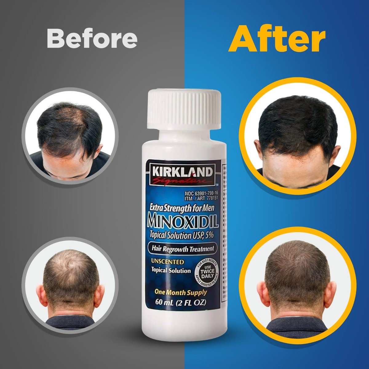 Kirkland Signature 5% Minoxidil Hair Regrowth for Men – 1 Month Supply (2 Fl Oz, Pack of 1) Avelisse