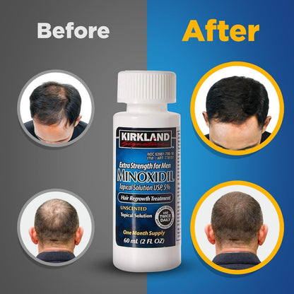 Kirkland Signature 5% Minoxidil Hair Regrowth for Men – 1 Month Supply (2 Fl Oz, Pack of 1) Avelisse