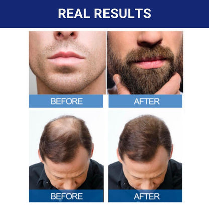 Kirkland Signature 5% Minoxidil Hair Regrowth for Men – 1 Month Supply (2 Fl Oz, Pack of 1) Avelisse
