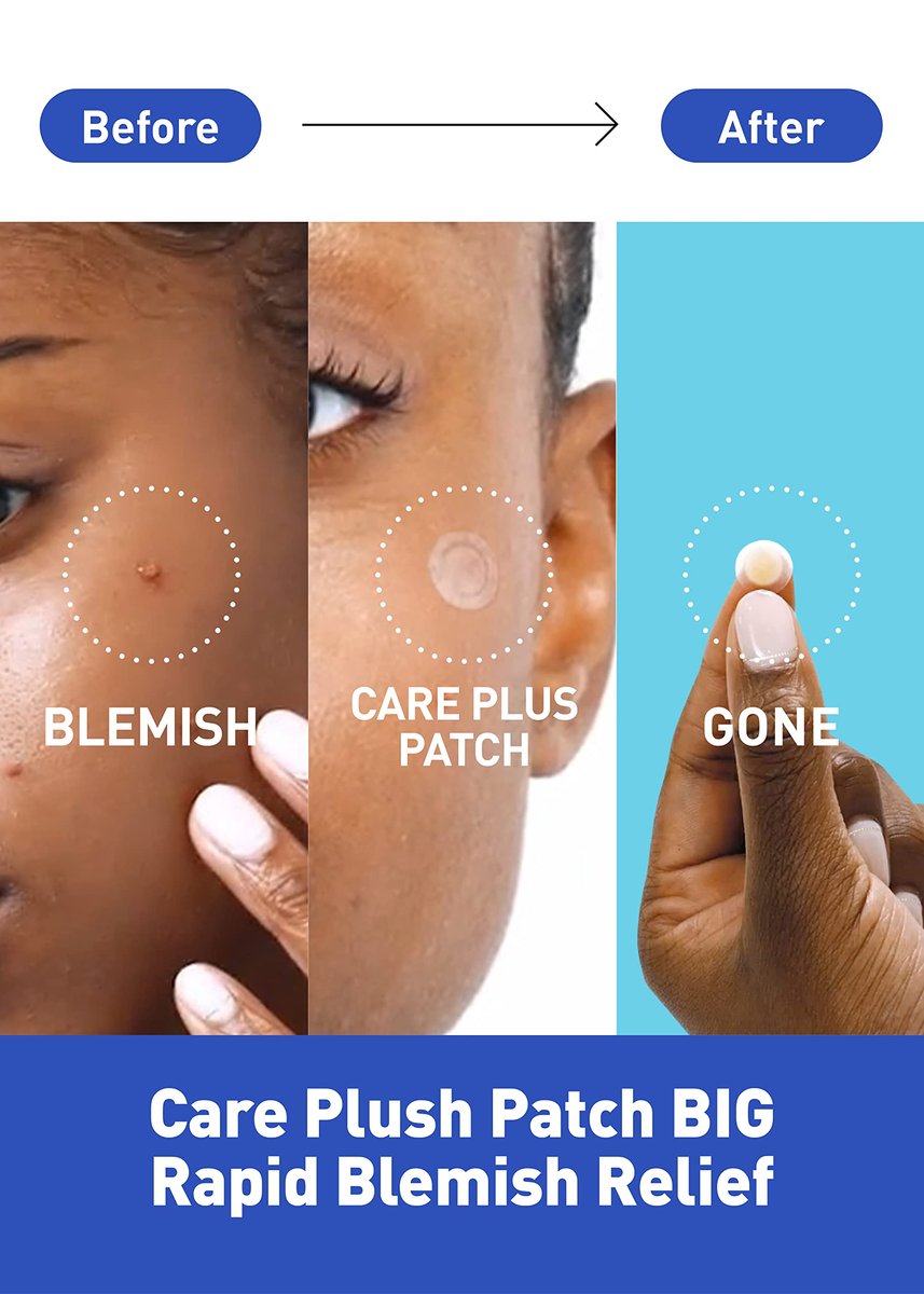 OLIVE YOUNG Care Plus Spot Patch Big (81 Count) - Hydrocolloid Acne Pimple Patches for Blemishes and Zits Avelisse