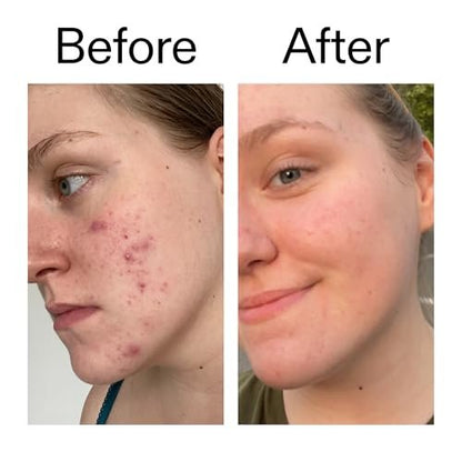 The INKEY List 15% Vitamin C and EGF Serum – 1 Fl Oz, Reduces Hyperpigmentation, Rejuvenating Serum for All Skin Types, Vegan