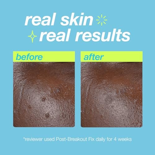 Dermalogica Clear Start Post-Breakout Fix - Acne Dark Spot Treatment with Salicylic Acid, Squalene & Hexylresorcinol, Fade + Brighten Acne Marks, 0.5 Fl Oz Avelisse