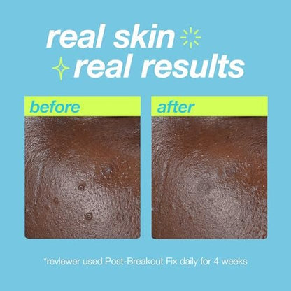 Dermalogica Clear Start Post-Breakout Fix - Acne Dark Spot Treatment with Salicylic Acid, Squalene & Hexylresorcinol, Fade + Brighten Acne Marks, 0.5 Fl Oz Avelisse