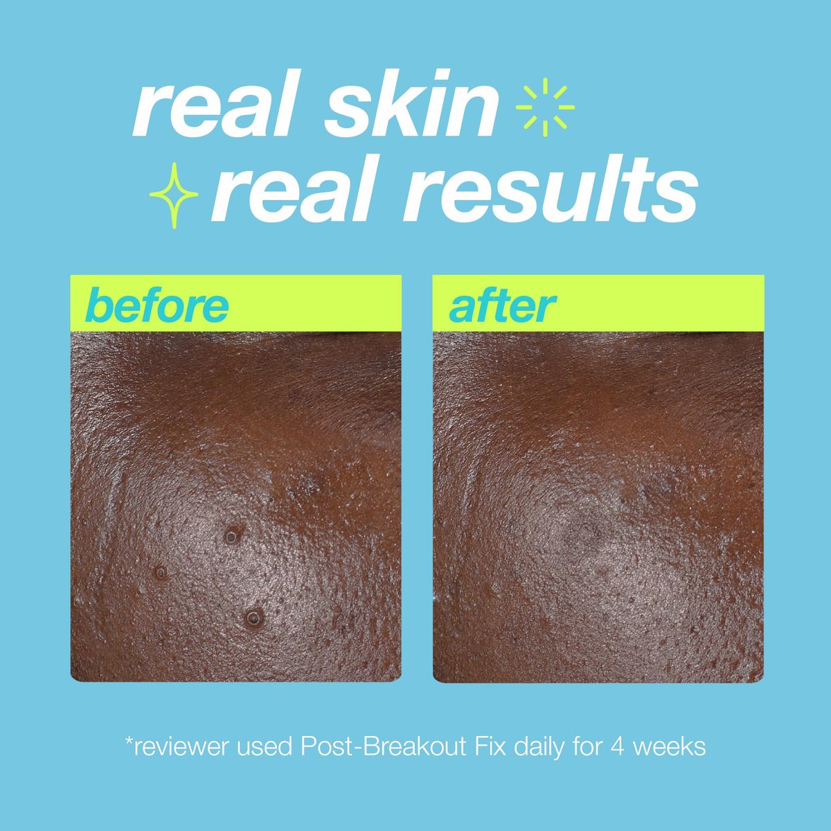 Dermalogica Clear Start Post-Breakout Fix - Acne Dark Spot Treatment with Salicylic Acid, Squalene & Hexylresorcinol, Fade + Brighten Acne Marks, 0.5 Fl Oz Avelisse