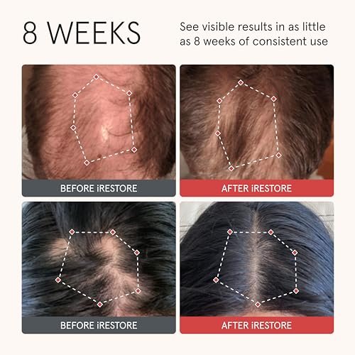 iRESTORE Biotin Hair Conditioner for Damaged Dry Hair - Volumizing & Thickening Conditioner with Ginseng & Argan Oil, Moisturizing for Fine Hair Growth, Pairs with Hair Loss Shampoo Avelisse