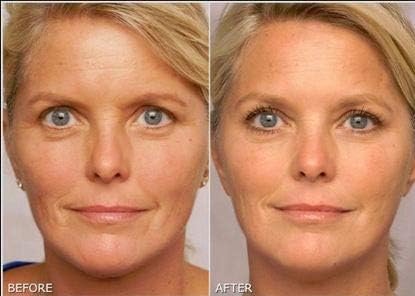 Retinol Gel 0.1% Vitamin A – Anti-Aging Formula for Fine Lines, Wrinkles, Scars & Sun Spots (20g) Avelisse