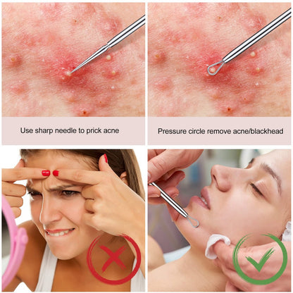 Titanium Lancet Needle Pimple Popper Tool - Professional Blackhead & Blemish Remover (2 Pack) with Box
