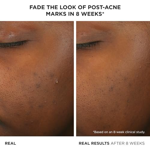 IT Cosmetics Bye Bye Breakout Acne Treatment Face Serum - 2% Salicylic Acid & 3% Lactic Acid - Reduces Pimples in 3 Days & Fades Post-Acne Marks in 8 Weeks - 1 Fl. Oz Avelisse
