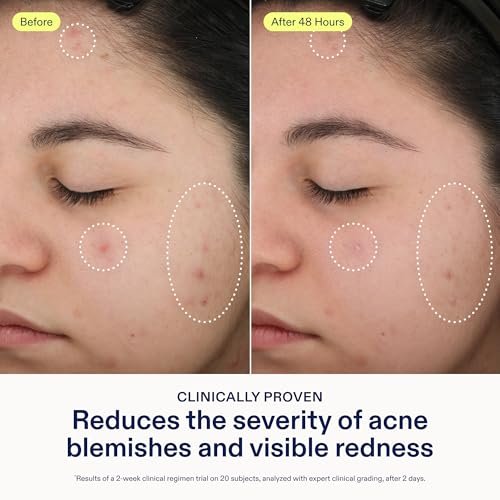 Skinfix 2% BHA Spot Treatment with Niacinamide - 0.5 fl oz - Acne & Blackhead Clearing Serum - Fragrance Free, Vegan & Cruelty Free Avelisse