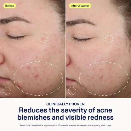 Skinfix 2% BHA Spot Treatment with Niacinamide - 0.5 fl oz - Acne & Blackhead Clearing Serum - Fragrance Free, Vegan & Cruelty Free Avelisse