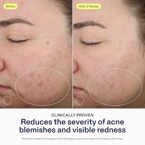 Skinfix 2% BHA Spot Treatment with Niacinamide - 0.5 fl oz - Acne & Blackhead Clearing Serum - Fragrance Free, Vegan & Cruelty Free Avelisse