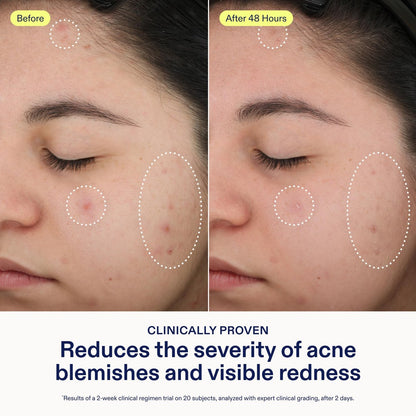 Skinfix 2% BHA Spot Treatment with Niacinamide - 0.5 fl oz - Acne & Blackhead Clearing Serum - Fragrance Free, Vegan & Cruelty Free Avelisse