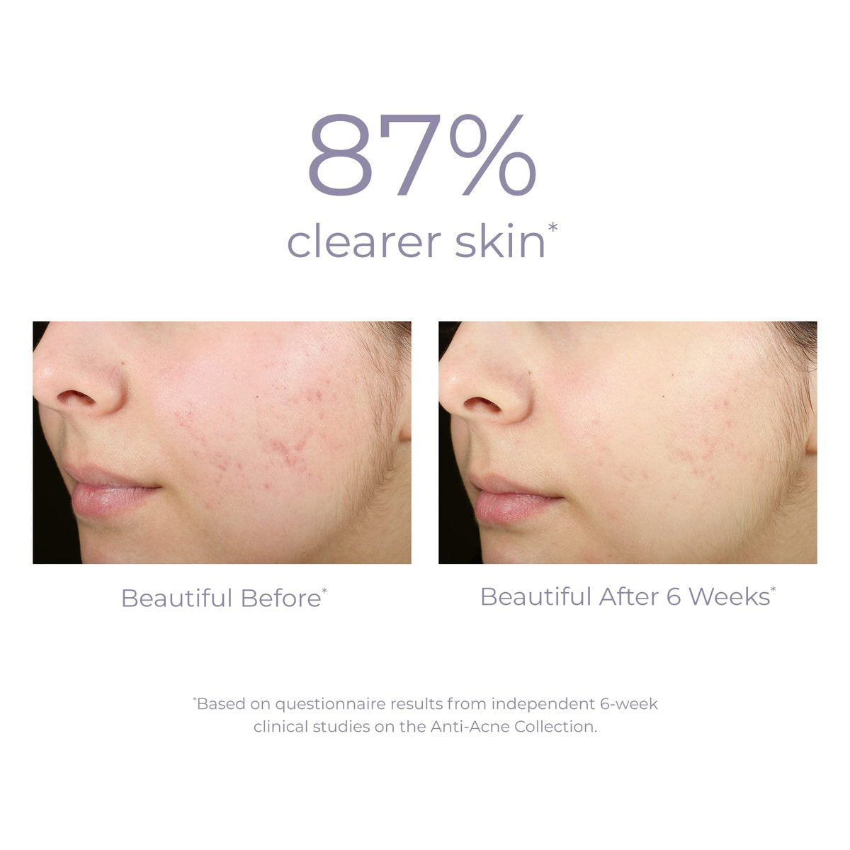 DERMA E Acne Spot Treatment - Clinically Studied Blemish Control Serum for Blackheads, Breakouts & Cystic Acne, 2 Fl Oz Avelisse
