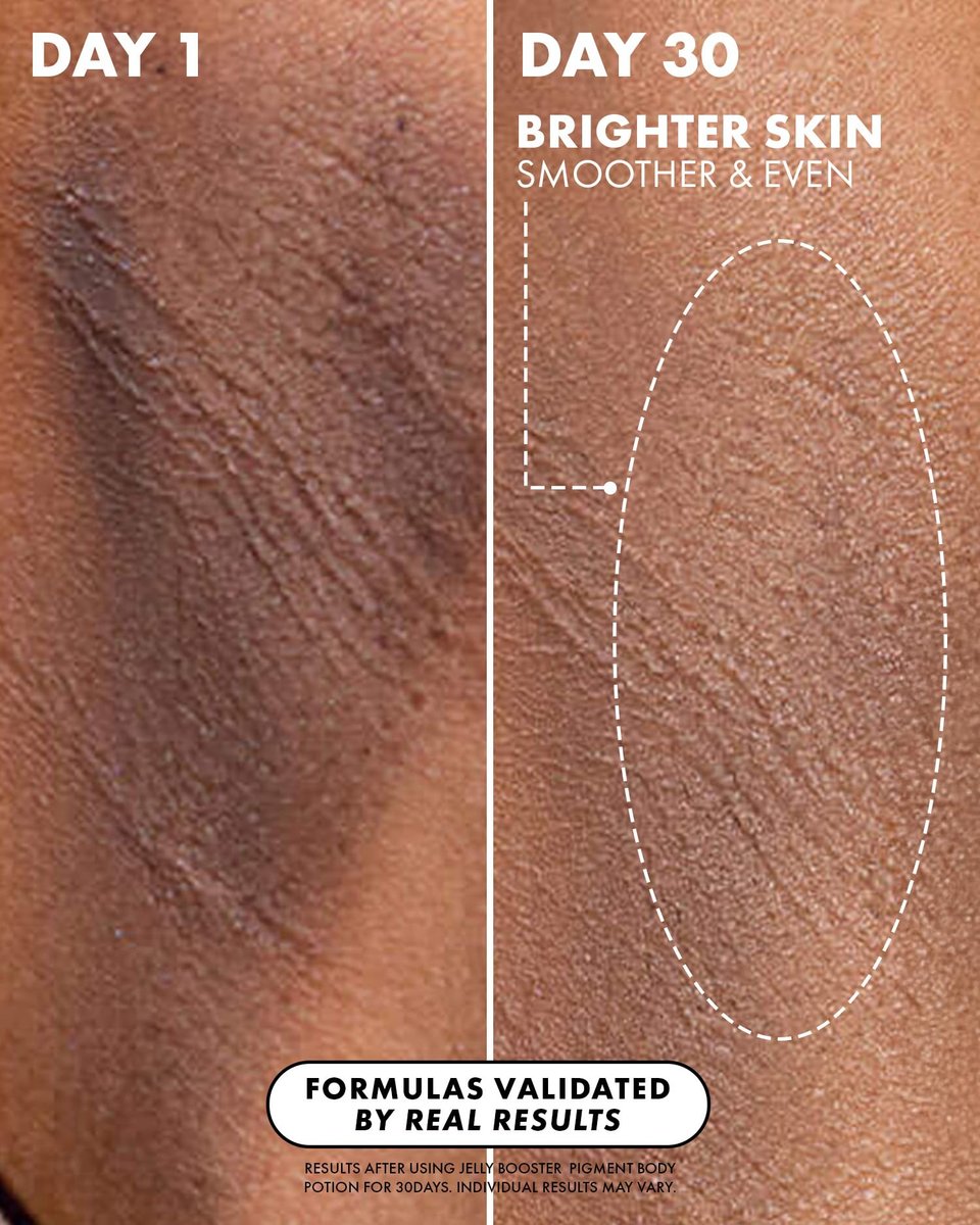 Truly Beauty Jelly Booster Pigment Body Potion - Lightweight Acne Scar Treatment for Face and Body, Fast Absorbing Scar Removal Serum, 3.1 Fl Oz Avelisse