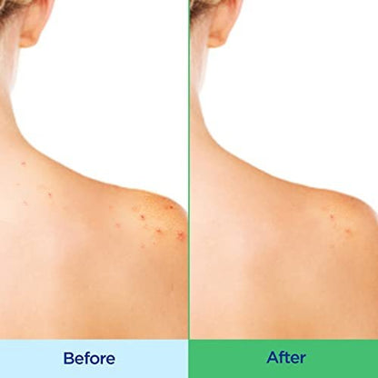 Differin Acne Body Wash with Salicylic Acid – Cream to Lather Formula for Back, Chest & Shoulders, 10 Oz