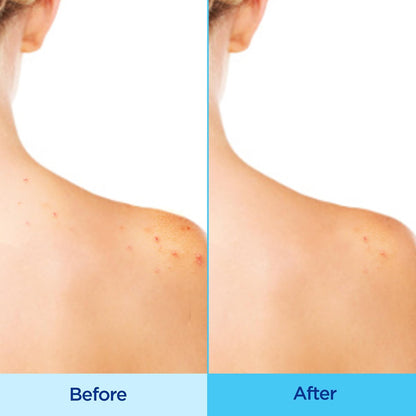 Differin Acne Body Spray with Salicylic Acid – 360° Treatment for Back, Chest & Shoulder Acne, 6 oz