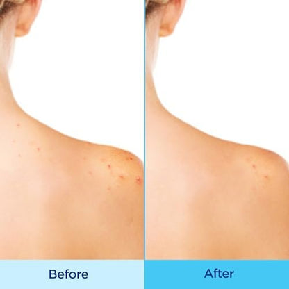 Differin Acne Body Spray with Salicylic Acid – 360° Treatment for Back, Chest & Shoulder Acne, 6 oz