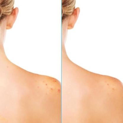 Differin Acne Body Spray with Salicylic Acid – 360° Treatment for Back, Chest & Shoulder Acne, 6 oz