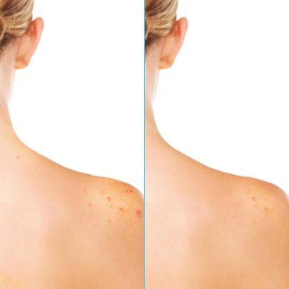 Differin Acne Body Spray with Salicylic Acid – 360° Treatment for Back, Chest & Shoulder Acne, 6 oz
