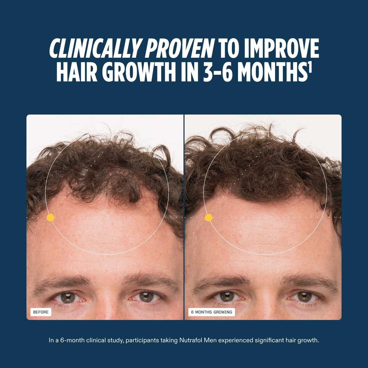 Nutrafol Men's Hair Growth Supplements – Clinically Tested for Thicker Hair & Scalp Coverage, Dermatologist Recommended, 2-Month Supply (2 Refill Pouches) Avelisse
