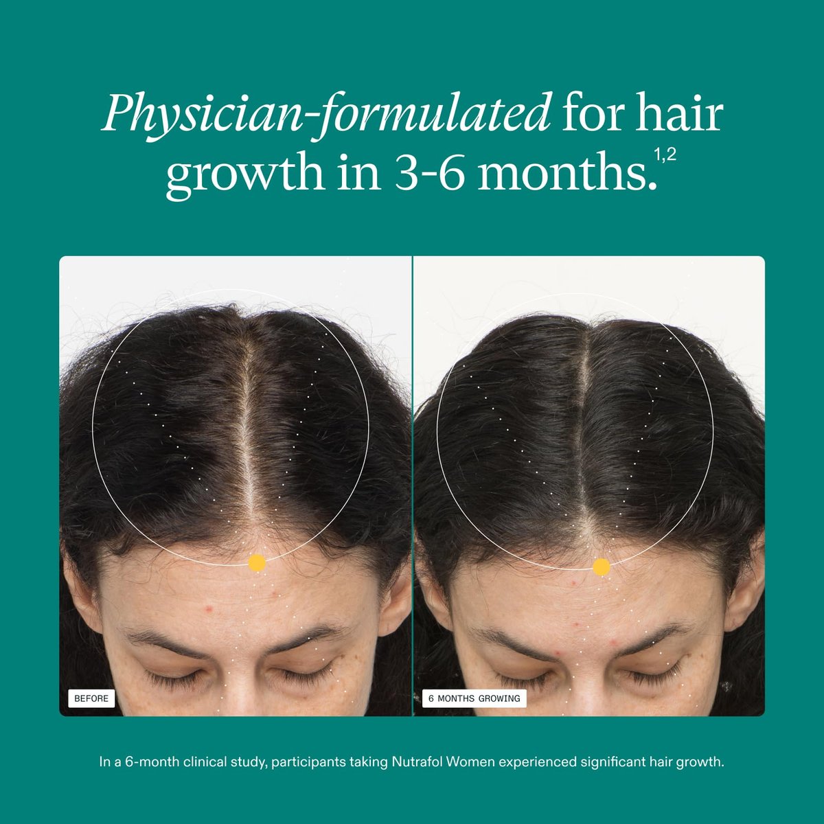 Nutrafol Women's Hair Growth Supplements, Ages 18-44, Clinically Proven for Visibly Thicker and Stronger Hair in 3-6 Months, Dermatologist Recommended - 2 Month Supply (2 Refill Pouches) Avelisse