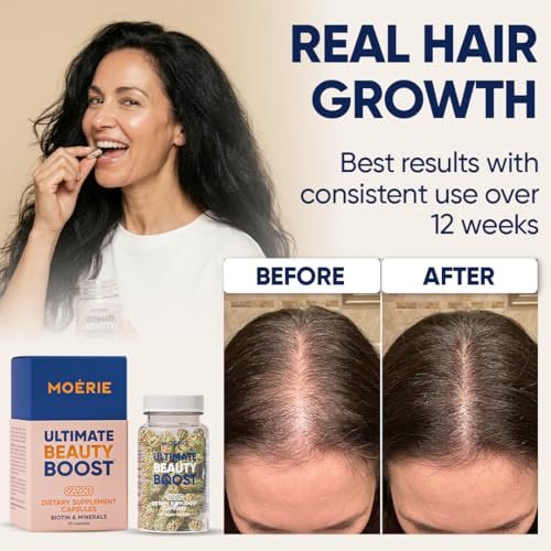 Moerie Ultimate Hair Growth Supplements for Women & Men - Hair, Skin, Nails Vitamins with Biotin & Minerals - for Thicker, Fuller Hair & Hair Loss Treatment - 120 Capsules Avelisse