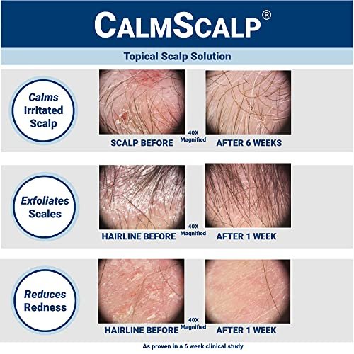 CalmScalp Scalp Treatment - Itch Relief & Exfoliating Scalp Care for Healthier Hair - 4 oz Avelisse