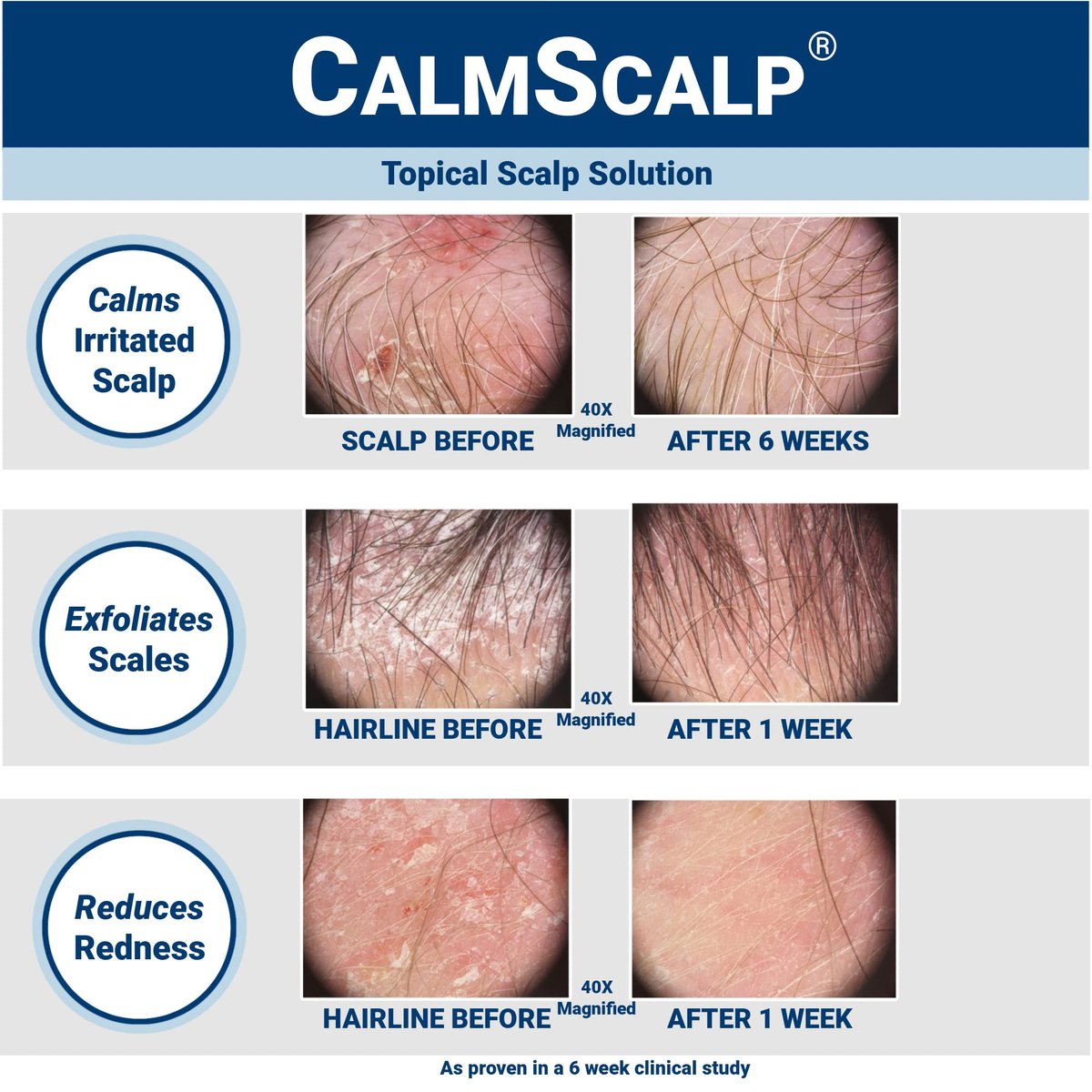 CalmScalp Scalp Treatment - Itch Relief & Exfoliating Scalp Care for Healthier Hair - 4 oz Avelisse
