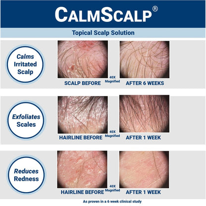 CalmScalp Scalp Treatment - Itch Relief & Exfoliating Scalp Care for Healthier Hair - 4 oz Avelisse