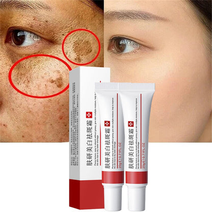 Whitening Freckle Cream 2-Pack – Acne Scar Removal & Pigmentation Treatment for Face, Moisturizing Dark Spot Corrector for Melasma, Wrinkles & Blemishes