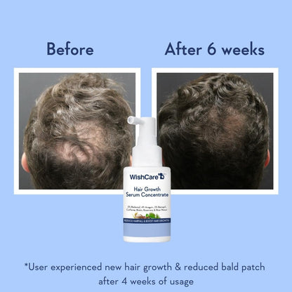 WishCare Hair Growth Serum Concentrate – Rosemary, 3% Redensyl, 4% Anagain, 2% Baicapil, Caffeine, Biotin, Plant Keratin & Rice Water