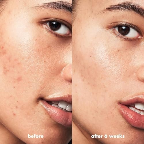 e.l.f. SKIN Blemish Breakthrough Blemish Control Basics Kit - Travel-Size Acne Skincare Routine with Cleanser, Serum & Moisturizer, Vegan & Cruelty-Free Avelisse