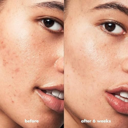 e.l.f. SKIN Blemish Breakthrough Blemish Control Basics Kit - Travel-Size Acne Skincare Routine with Cleanser, Serum & Moisturizer, Vegan & Cruelty-Free Avelisse
