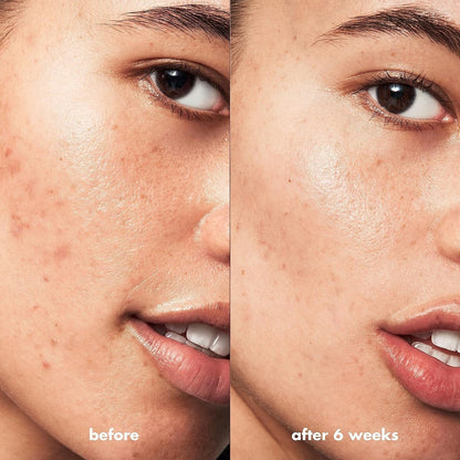 e.l.f. SKIN Blemish Breakthrough Blemish Control Basics Kit - Travel-Size Acne Skincare Routine with Cleanser, Serum & Moisturizer, Vegan & Cruelty-Free Avelisse