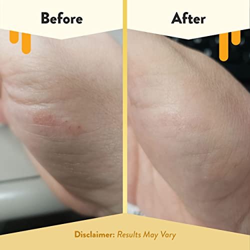 ECZEMA HONEY Itch Cooling Face & Body Rounds - Anti-Itch Cotton Face Pads - Moisturizer for Eczema, Dry & Sensitive Skin (50 Cotton Rounds) Avelisse