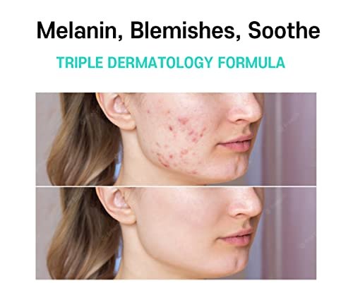 CARE:NEL Melasma Treatment Face Cream - Dark Spot Remover with Centella Asiatica - Korean Skin Care 40ml Avelisse